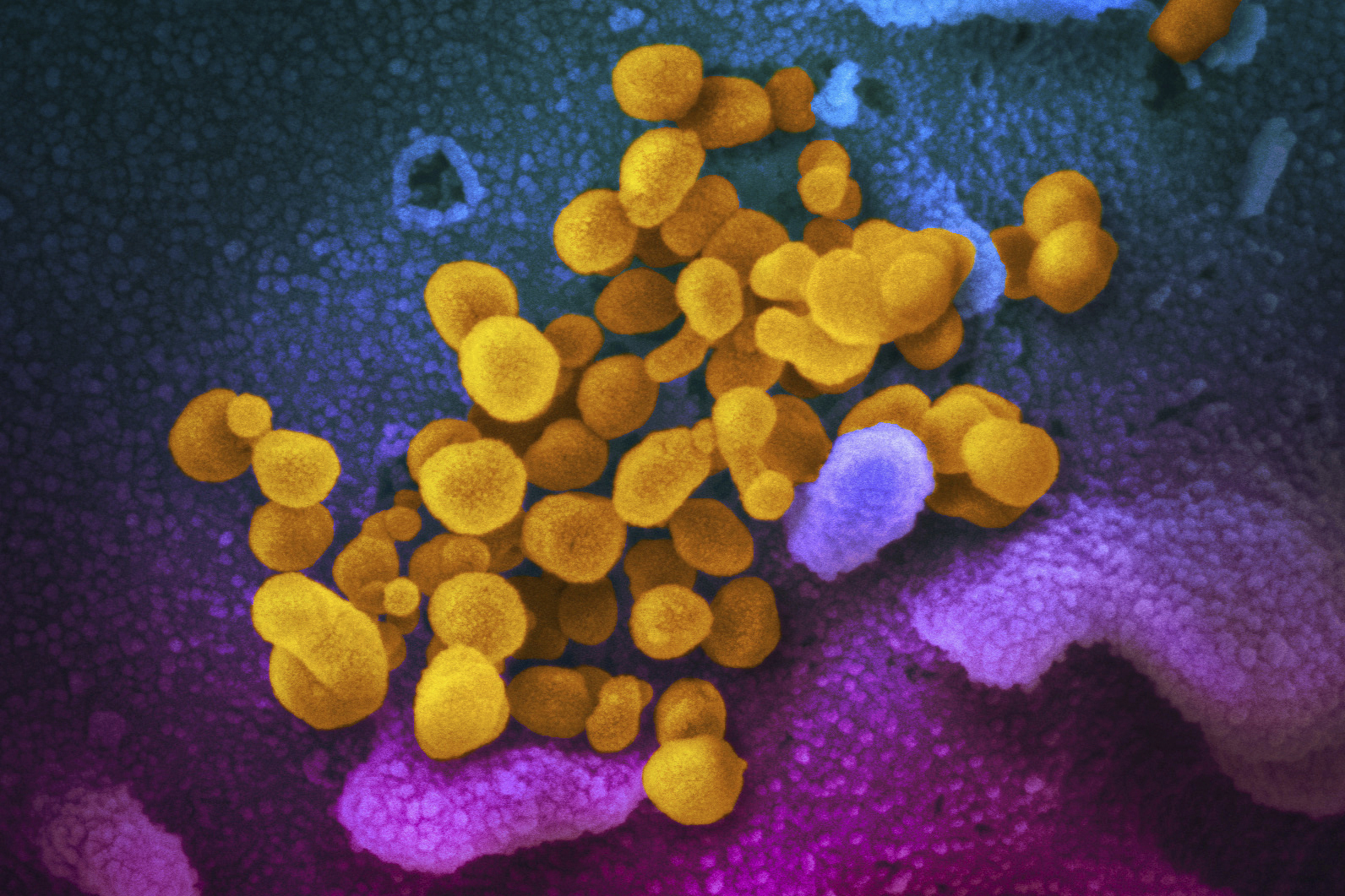 FILE - This undated, colorized electron microscope image made available by the U.S. National Institutes of Health in February 2020 shows the Novel Coronavirus SARS-CoV-2, indicated in yellow, emerging from the surface of cells, indicated in blue/pink, cultured in a laboratory. The National Institutes of Health is opening a handful of studies to start testing possible treatments for long COVID, an anxiously awaited step in U.S. efforts against the mysterious condition. The announcement, Monday, July 31, 2023 comes amid frustration from patients who've struggled for months or years with sometimes disabling health problems. (NIAID-RML via AP, File)