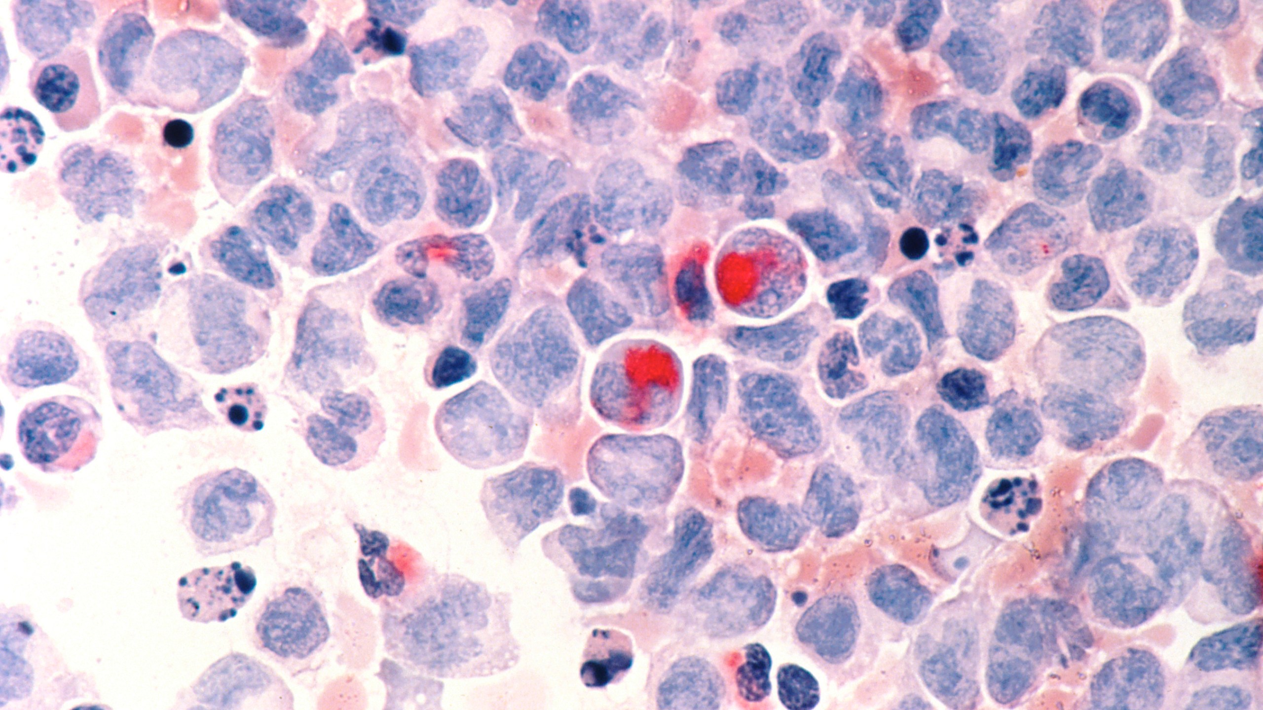 This March 1988 microscope photo provided by the National Cancer Institute shows human cells with acute myelocytic leukemia. Advances in childhood cancer are a success story in modern medicine. But in the past decade, those strides have stalled for Black and Hispanic youth, opening a gap in death rates, according to a new report published Thursday, Nov. 16, 2023. (National Cancer Institute via AP)