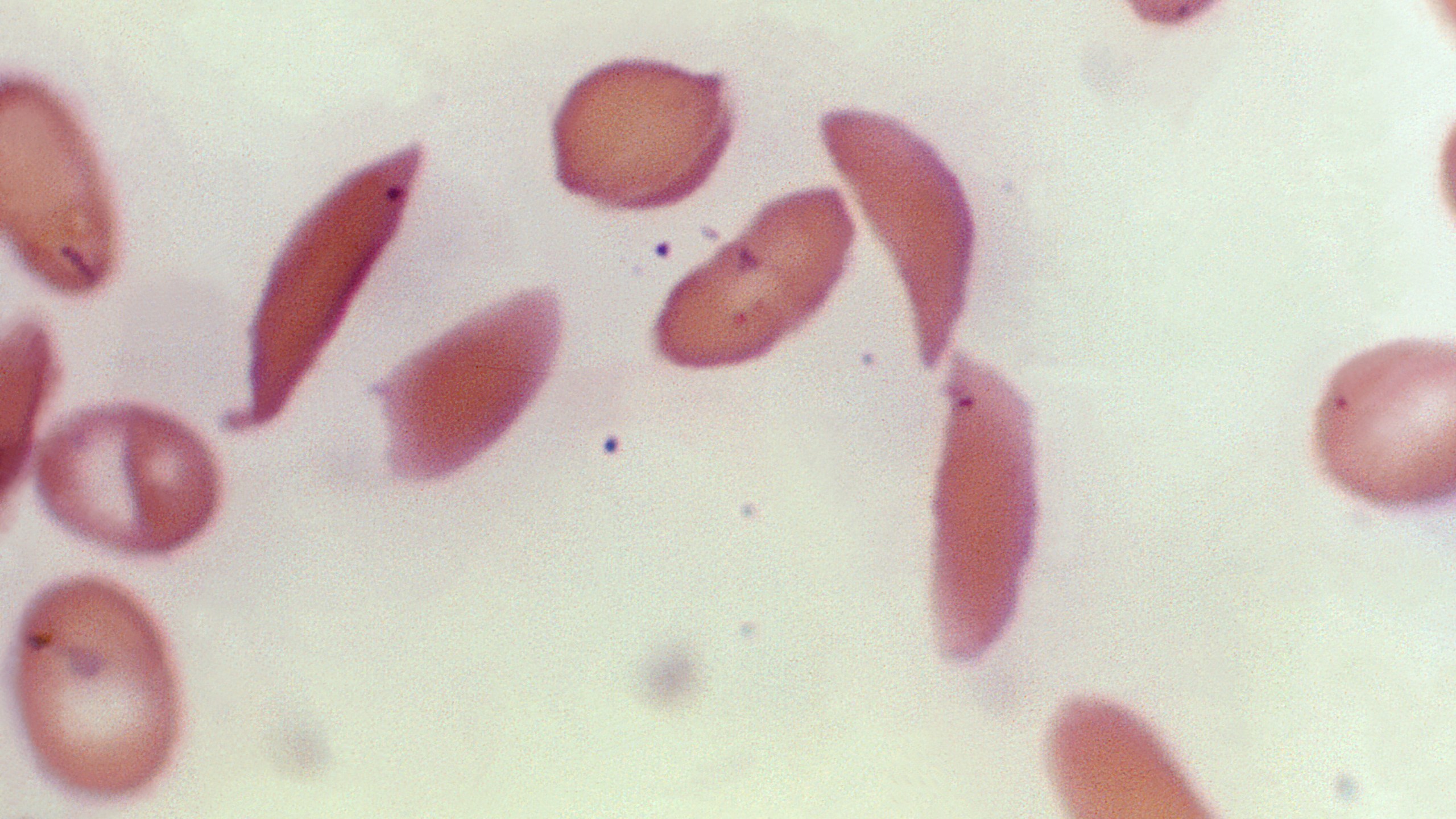 FILE - This microscope photo provided on Oct. 25, 2023, by the Centers for Disease Control and Prevention shows crescent-shaped red blood cells from a sickle cell disease patient in 1972. Britain's medicines regulator has authorized the world's first gene therapy treatment for sickle cell disease, in a move that could offer relief to thousands of people with the crippling disease in the U.K. In a statement on Thursday, Nov. 16, 2023, the Medicines and Healthcare Regulatory Agency said it approved Casgevy, the first medicine licensed using the gene editing tool CRISPR, which won its makers a Nobel prize in 2020. (Dr. F. Gilbert/CDC via AP, File )