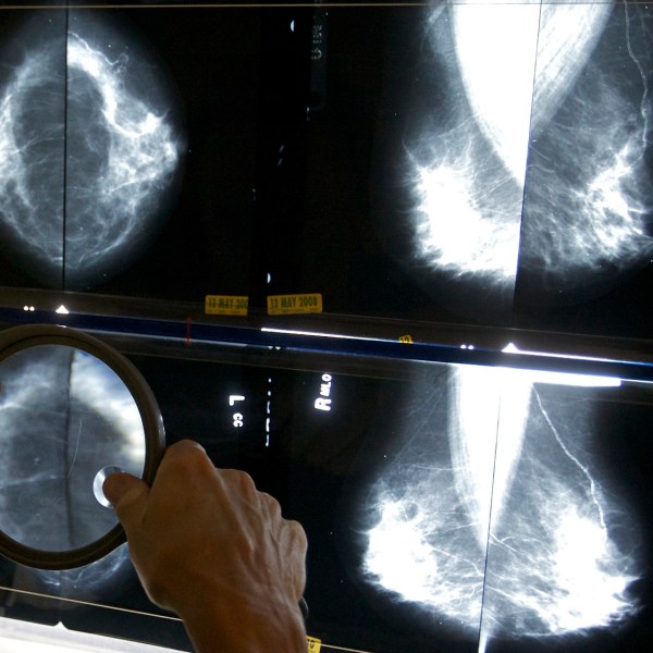 FILE - A radiologist uses a magnifying glass to check mammograms for breast cancer in Los Angeles, May 6, 2010. Annual mammograms are now recommended indefinitely for breast cancer survivors in many countries including the United States. Now a large British study finds that less frequent screening is just as good. The findings were being discussed Friday, Dec. 8, 2023 at the San Antonio Breast Cancer Symposium. (AP Photo/Damian Dovarganes, File)