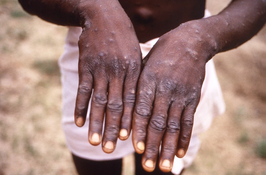 FILE - This 1997 image provided by the CDC during an investigation into an outbreak of monkeypox, which took place in the Democratic Republic of the Congo (DRC), formerly Zaire, depicts the dorsal surfaces of the hands of a monkeypox case patient, who was displaying the appearance of the characteristic rash during its recuperative stage. As Congo copes with its biggest outbreak of mpox, scientists warn discrimination against gay and bisexual men on the continent could make it worse. (CDC via AP, File)