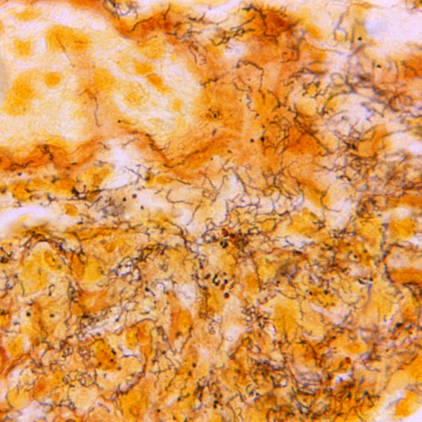 FILE - This 1966 microscope photo made available by the Centers for Disease Control and Prevention shows a tissue sample with the presence of numerous, corkscrew-shaped, darkly-stained, Treponema pallidum spirochetes, the bacterium responsible for causing syphilis. The U.S. syphilis epidemic continues to worsen, according to a new government report released Tuesday, Jan. 30, 2024, that also contains some unexpected good news — the rate of new gonorrhea cases has fallen for the first time in a decade. (Skip Van Orden/CDC via AP, File)