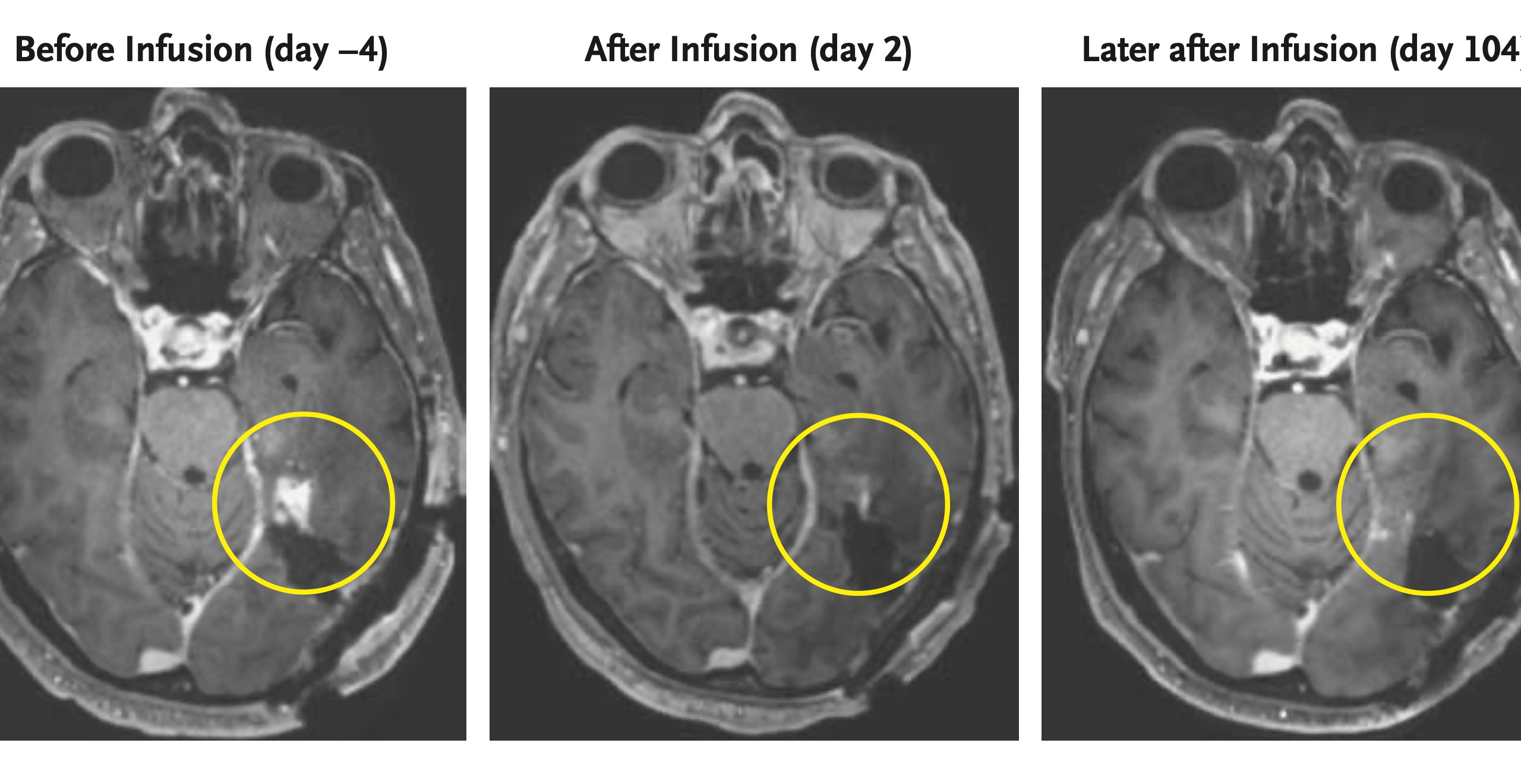 This combination of MRI scan images provided by the New England Journal of Medicine in March 2024 shows the progress of a glioblastoma patient who received CAR-T therapy which uses modified versions of T cells from a patient's own immune system. Studies published by the New England Journal of Medicine on Wednesday, March 13, 2024, signals a new strategy to fight glioblastoma by turning immune cells into “living drugs” that attack the brain cancer. (NEJM via AP)