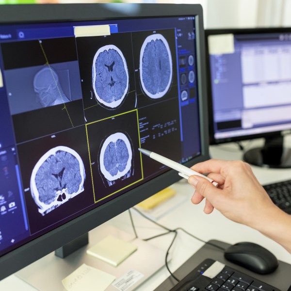 Close-up of female doctor looking at CT scan report on computer monitor. Surgeon with pen viewing at X-ray image on computer screen in hospital.