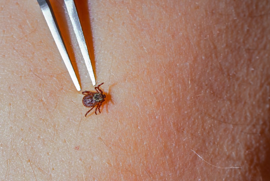 A tick can be seen on the skin of a human next to a pair of tweezers. 