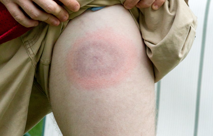 A very large Lyme disease bullseye appears on young mans leg.