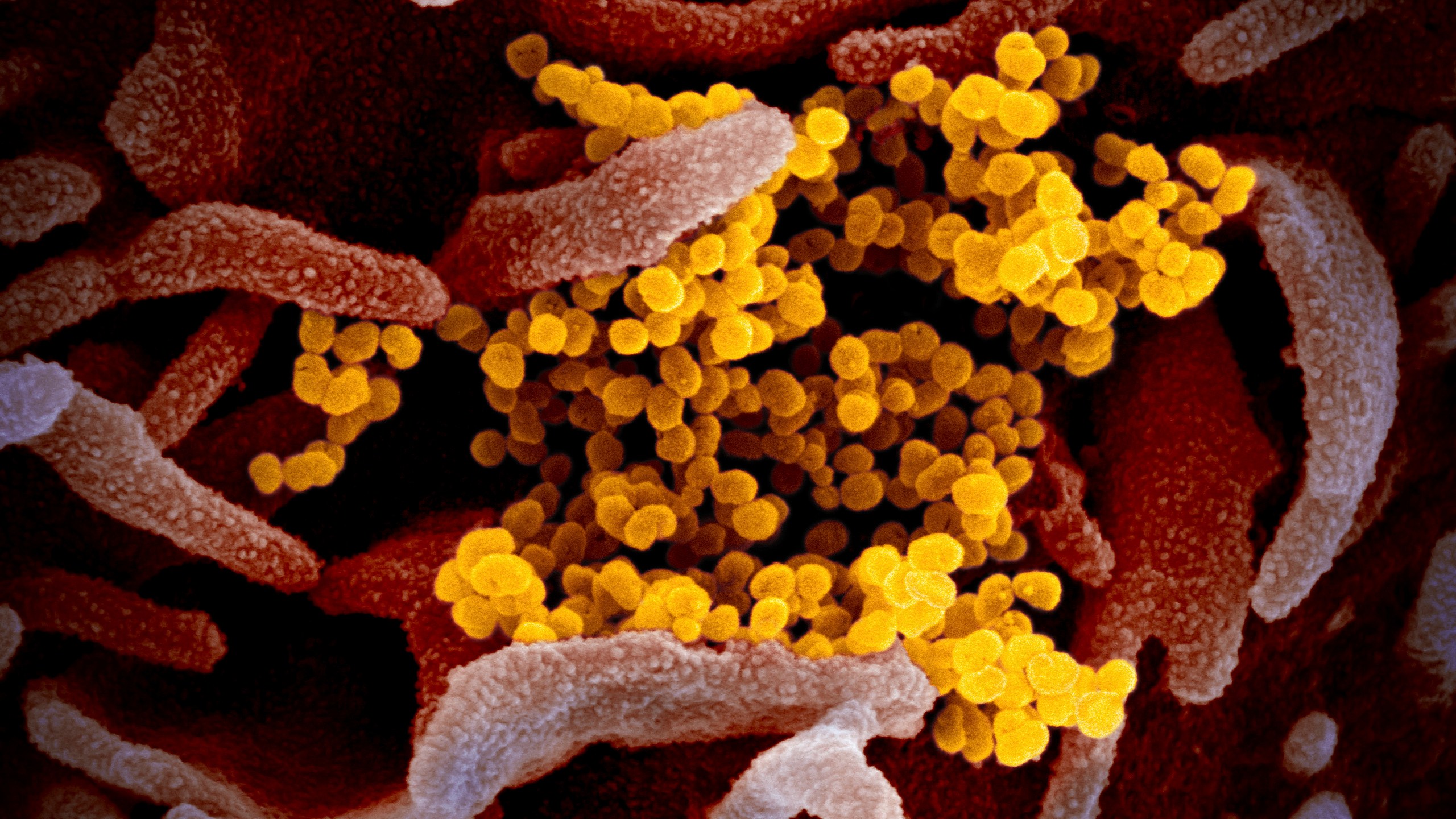 FILE - This undated electron microscope image made available by the U.S. National Institutes of Health in February 2020 shows the Novel Coronavirus SARS-CoV-2, yellow, emerging from the surface of cells, pink, cultured in the lab. Also known as 2019-nCoV, the virus causes COVID-19. The sample was isolated from a patient in the U.S. (NIAID-RML via AP, File)